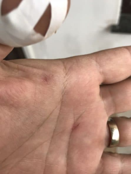 mici accidente de munca